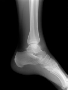 ankle-x-ray-1430507-226x300